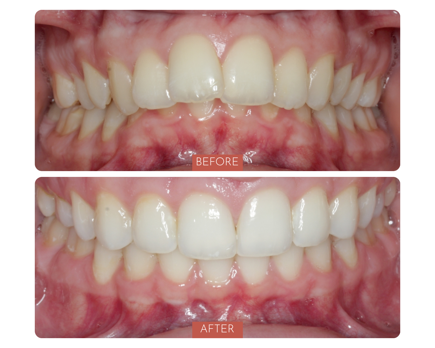 Comparison of teeth before and after dental treatment, showing improved alignment and whiteness in the after photo.