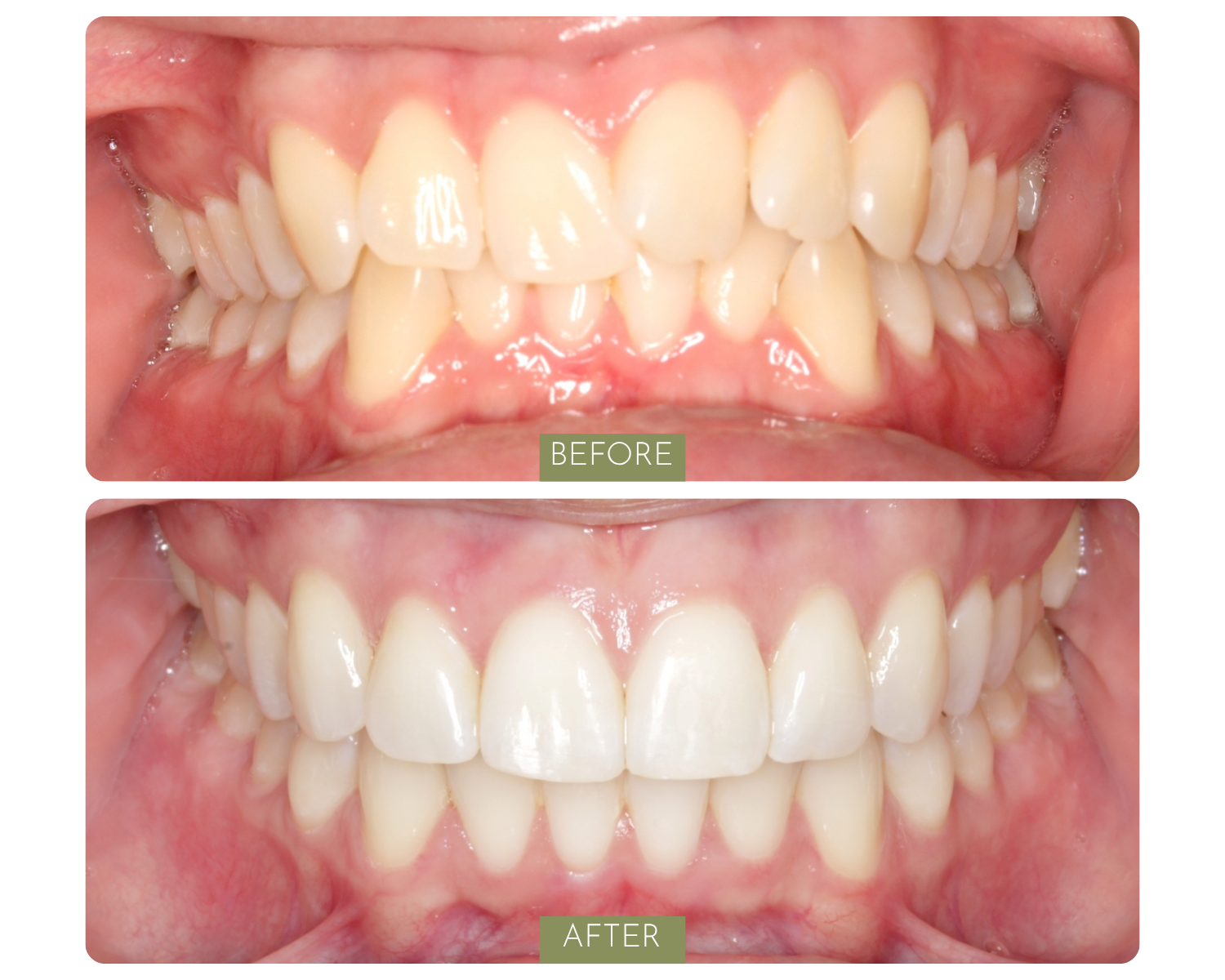 Comparison of teeth before and after dental treatment, showing improved alignment and whitening in the after image.