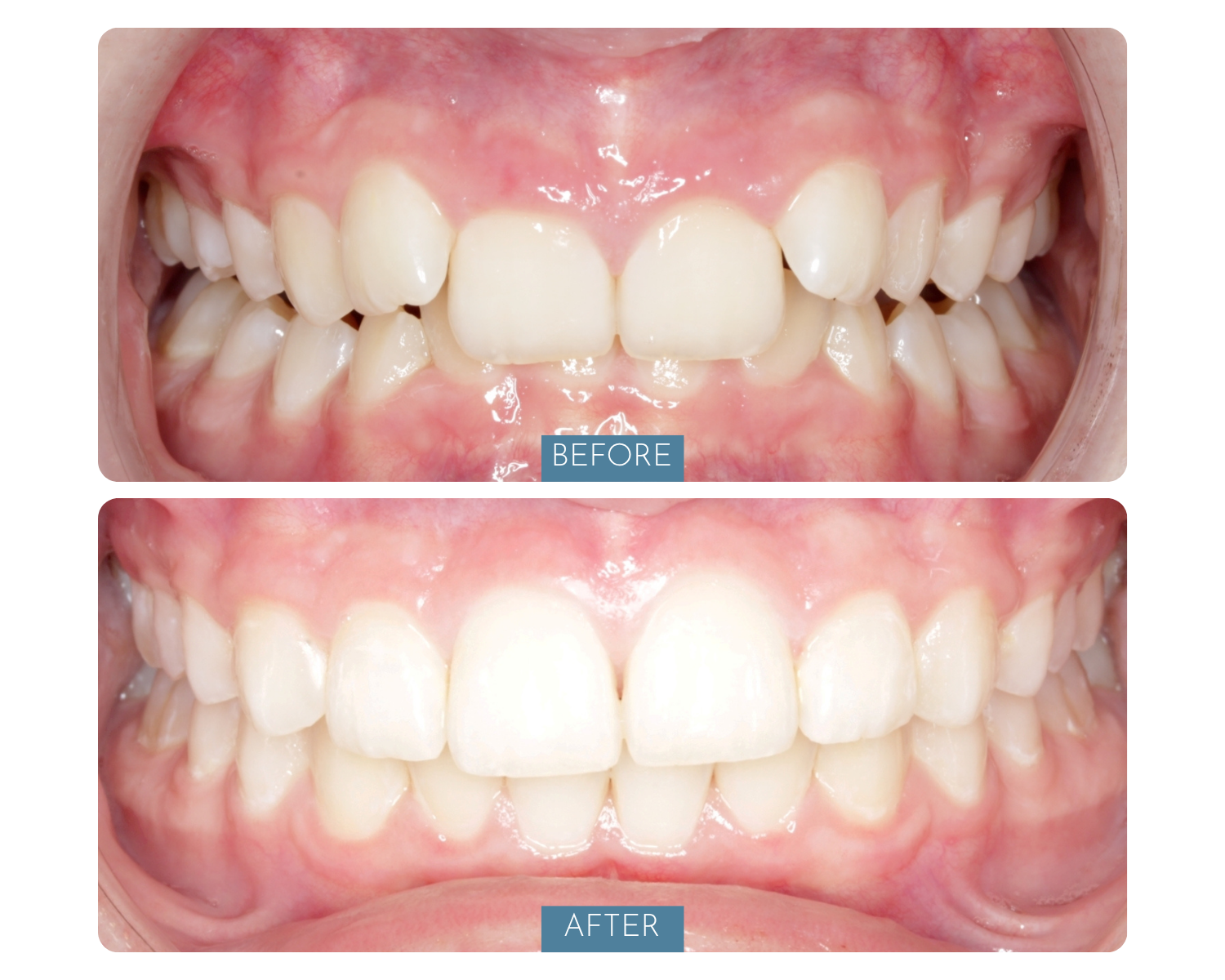 Comparison of teeth before and after orthodontic treatment. The top image shows misaligned teeth with crowding, and the bottom image shows straightened, aligned teeth after dental correction.