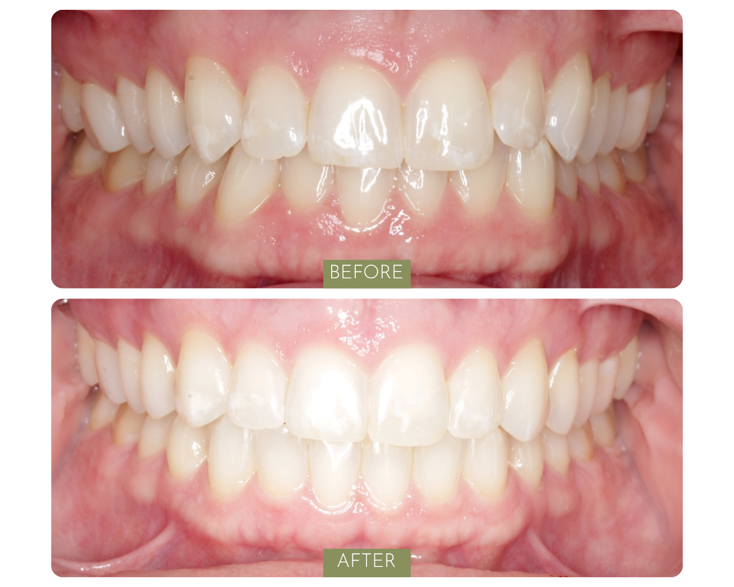 Comparison of teeth before and after dental treatment showing improved alignment and whitening. Top image labeled 'BEFORE' displays crooked and discolored teeth. Bottom image labeled 'AFTER' shows straighter, whiter teeth with better alignment.