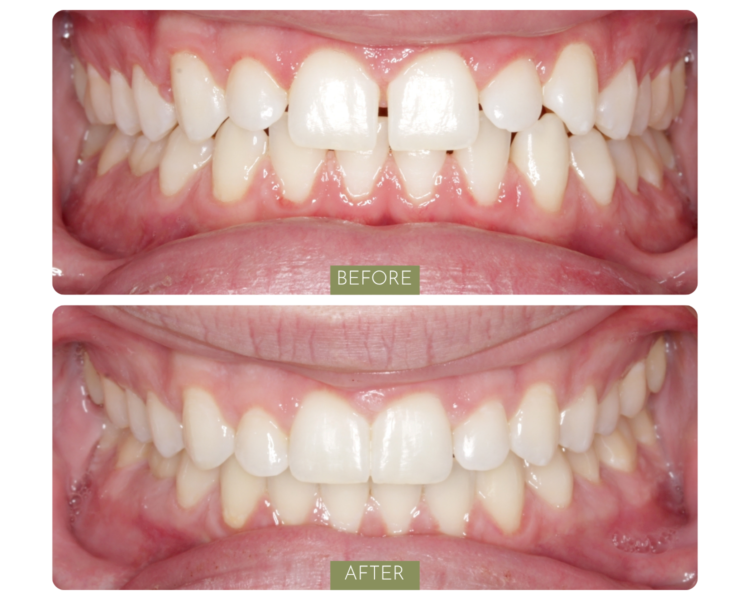 Comparison of teeth before and after dental treatment. The 'before' image shows misaligned and crowded teeth, while the 'after' image shows teeth that are straighter and more evenly spaced.
