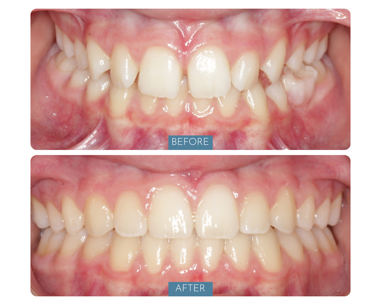 Comparison of teeth before and after dental treatment, showing improved alignment and appearance.