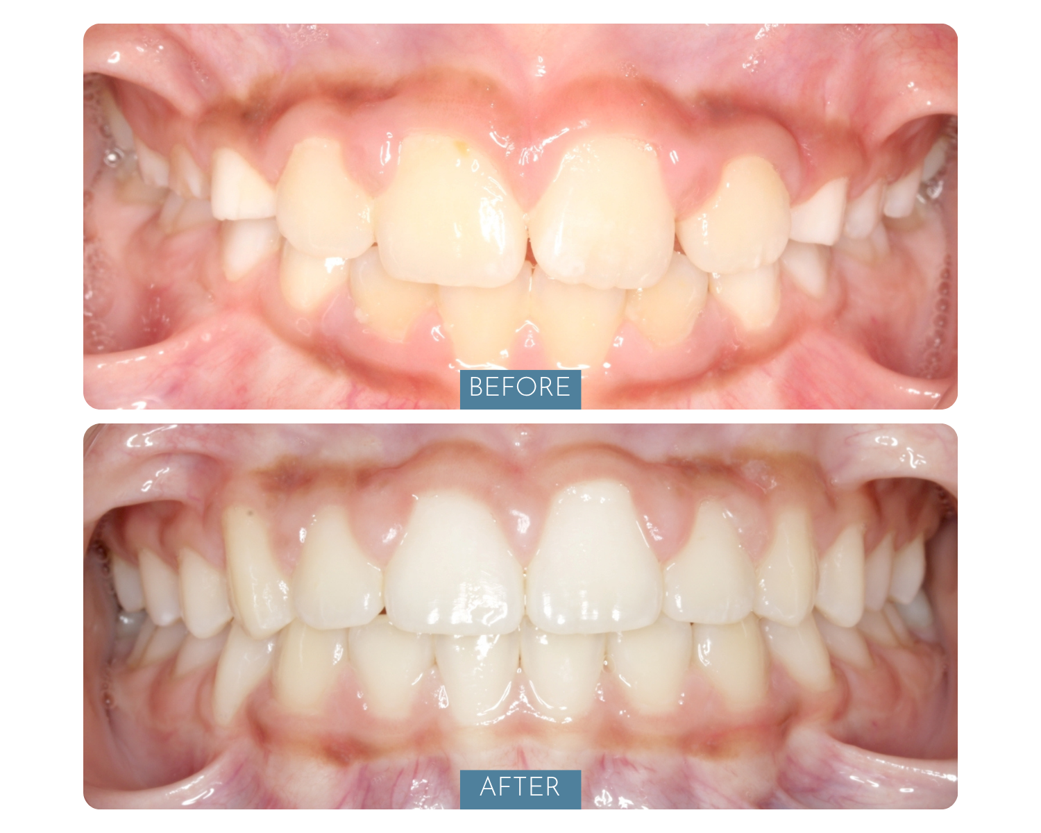 Comparison of teeth before and after dental treatment showing improved alignment and appearance of teeth