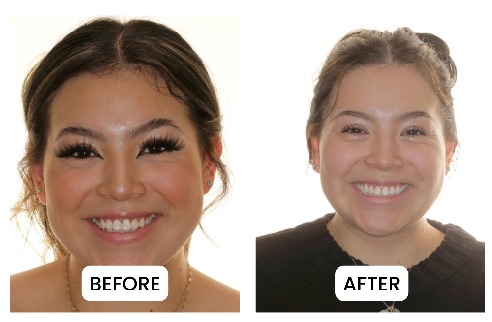 Before and after of a smile alignment treatment in Idaho Falls