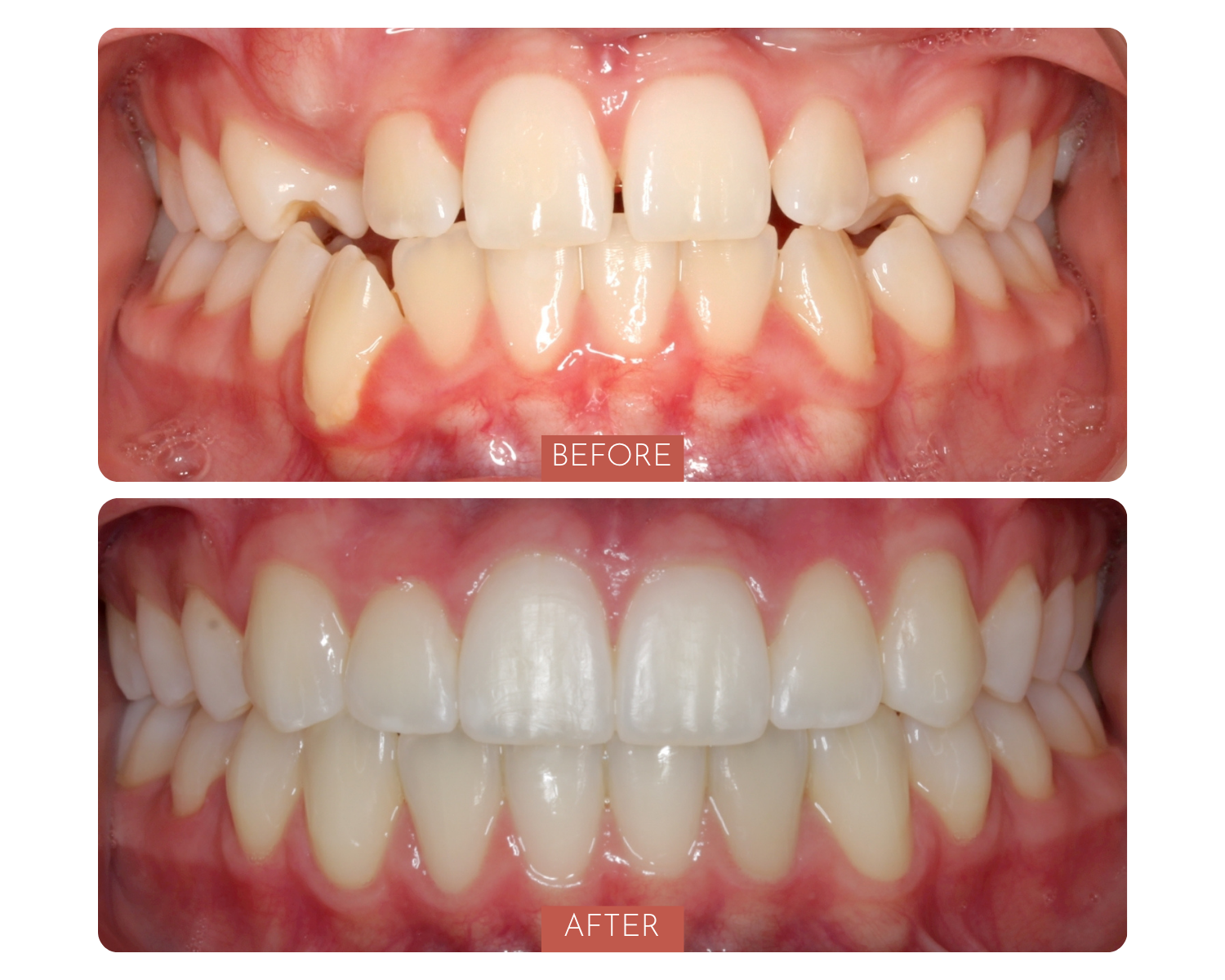 Comparison of teeth before and after orthodontic treatment showing straighter, more aligned teeth in the after image.