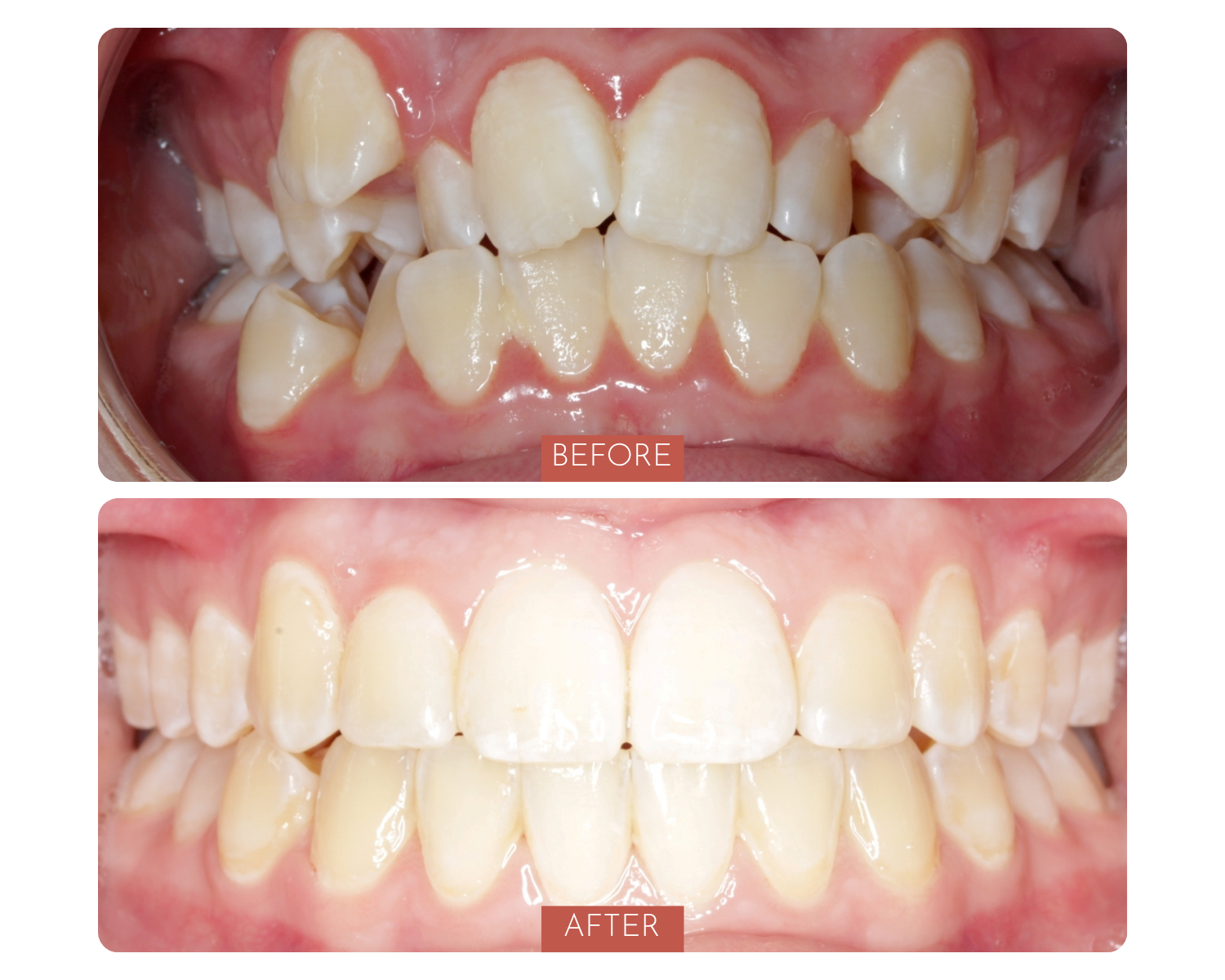 Comparison of teeth before and after dental treatment. The top image shows crowded and misaligned teeth, while the bottom image shows straightened and aligned teeth after treatment.