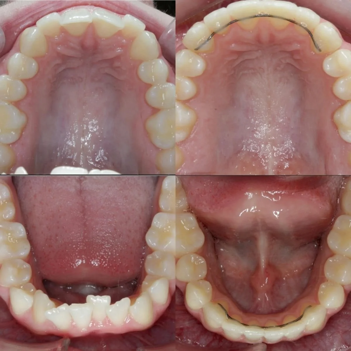 Before and after images of a detail and finishing treatment on a patient