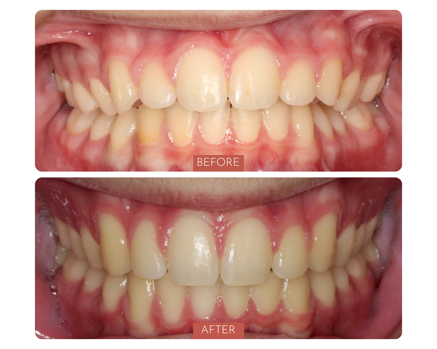 Comparison of teeth before and after dental treatment showing improved alignment and whitening in the 'after' image.