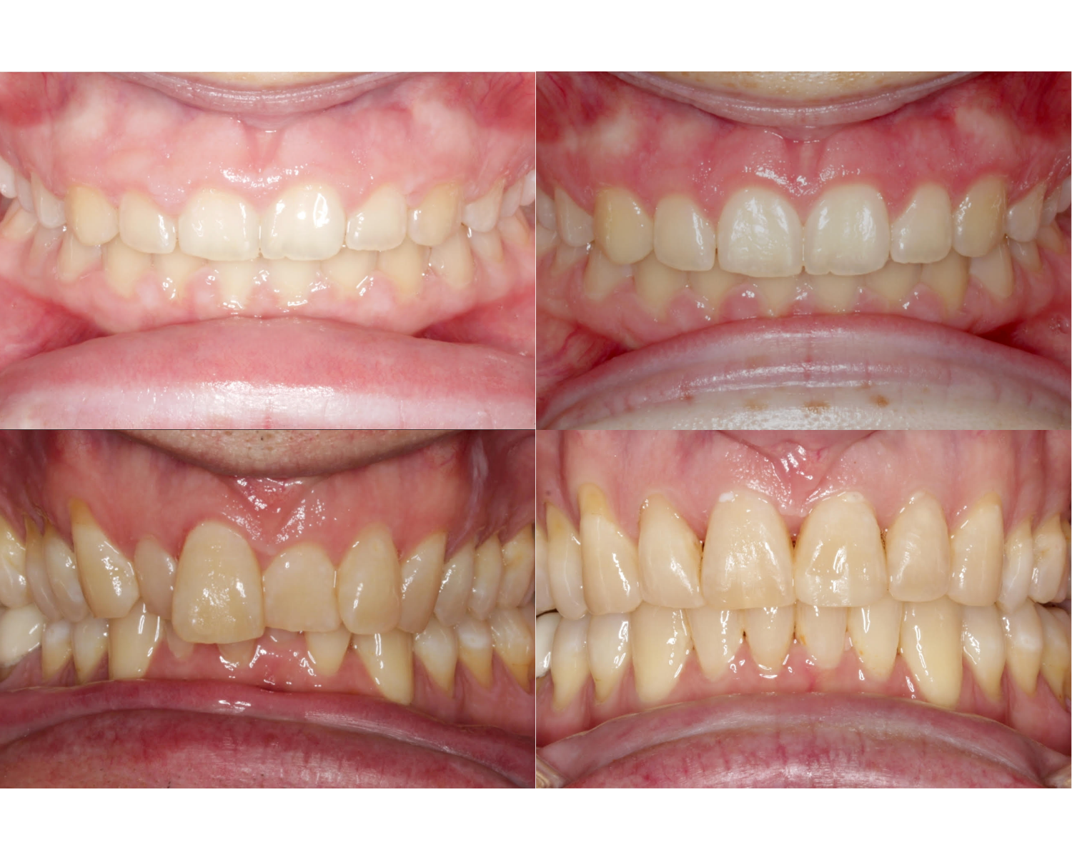 Comparison of dental images showing before and after orthodontic treatment, highlighting changes in tooth alignment and spacing.