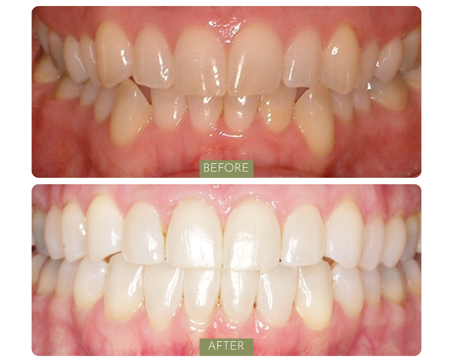 Comparison of teeth before and after dental treatment. The top image shows teeth that are crowded, crooked, and discolored. The bottom image shows teeth that are straight, evenly aligned, and whiter. The words 'Before' and 'After' are labeled on each