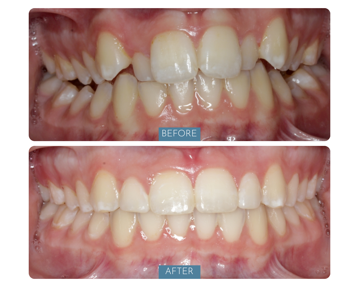 Comparison of teeth before and after dental treatment showing improved alignment and cleaning.