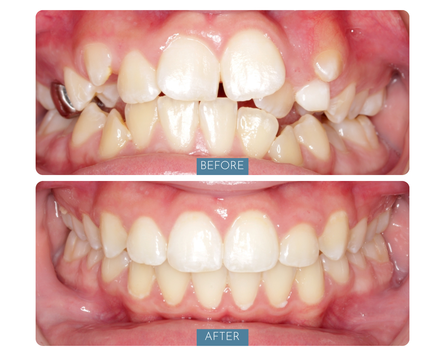 Comparison of teeth before and after dental treatment, showing improved alignment and appearance in the after image.