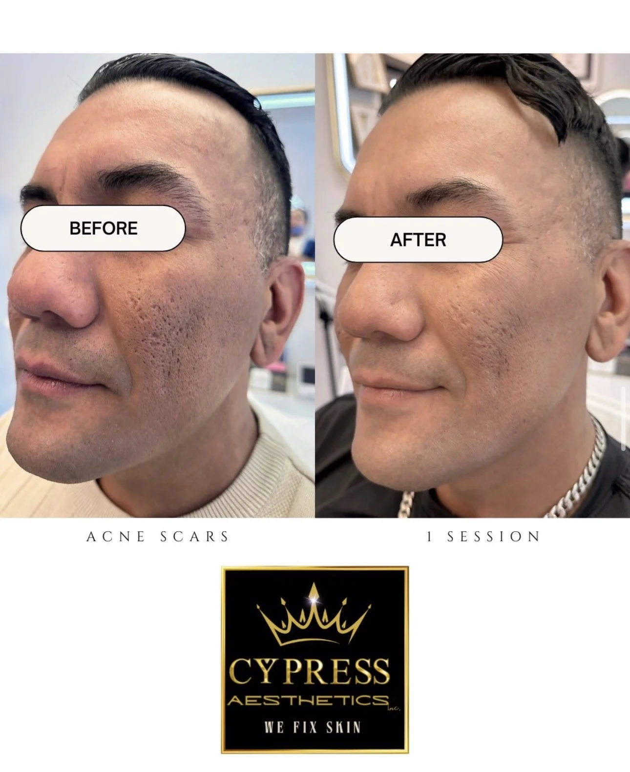 Side-by-side comparison of a man's face showing significant acne scars before and after a skincare treatment session. The left side labeled 'BEFORE' shows inflamed, pockmarked skin, while the right side labeled 'AFTER' shows smoother skin with reduced scars. Below, there is a logo for Cypress Aesthetics with the tagline 'We Fix Skin.'