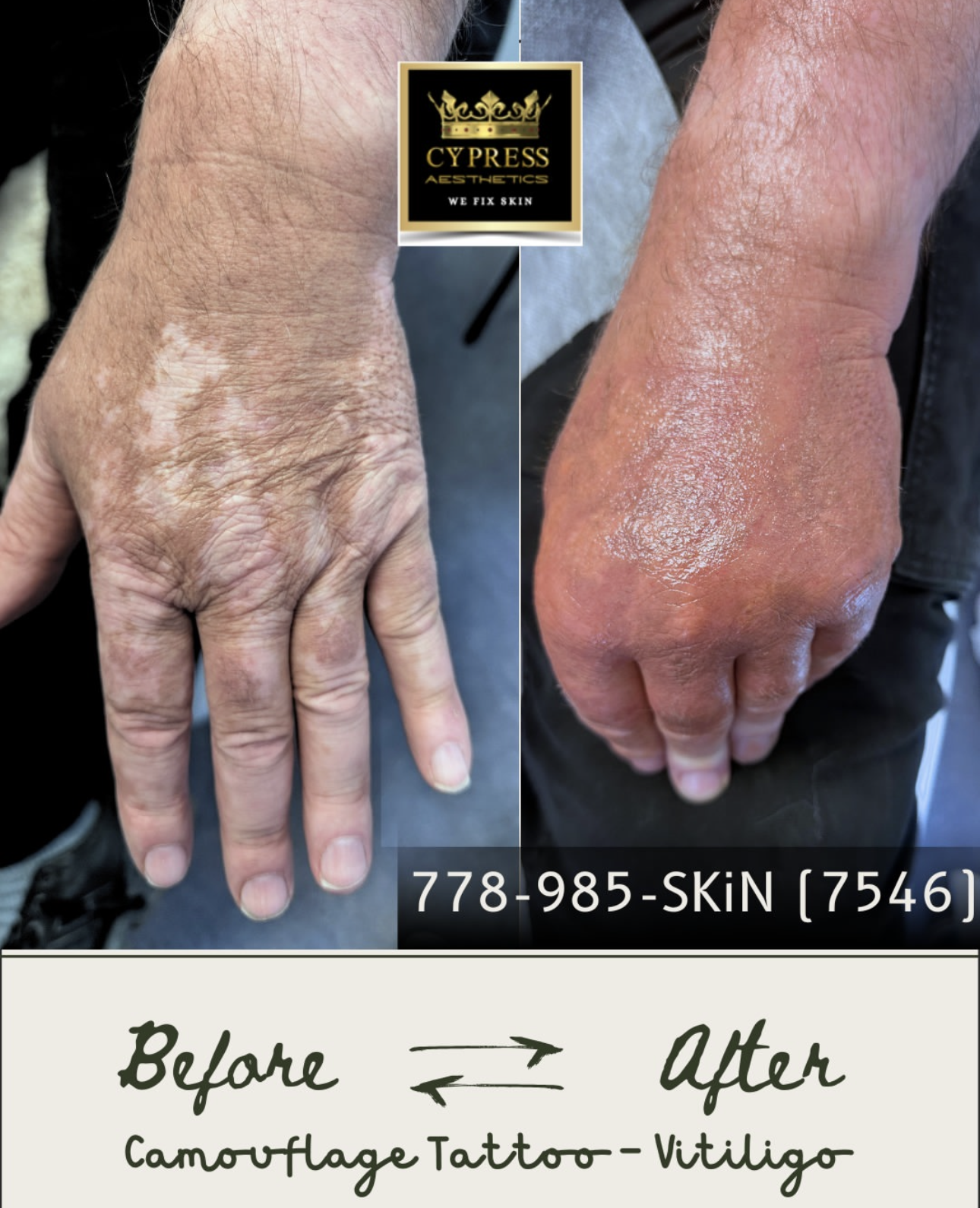 Comparison of hands showing skin improvement from before to after camouflage tattoo Vitiligo treatment with a logo for Cypress Aesthetics and a phone number at the top, and 'Before' and 'After' with arrows pointing to images.