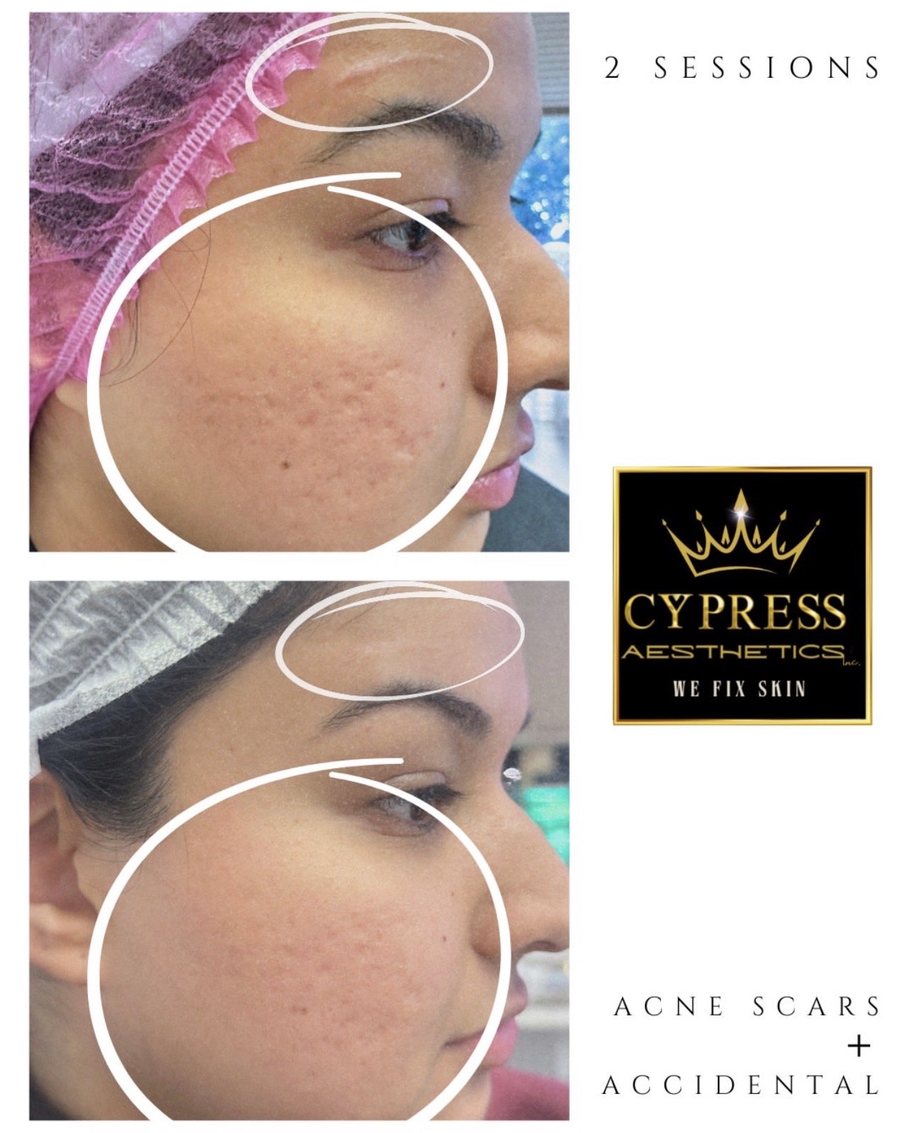 Before and after images of a woman's facial skin, showing improvements in acne scars and acne after two aesthetic treatment sessions by Cypress Aesthetics. The top image shows a woman with textured skin and acne scars, the bottom image shows smoother skin with fewer scars. The logo of Cypress Aesthetics is displayed on the right side.