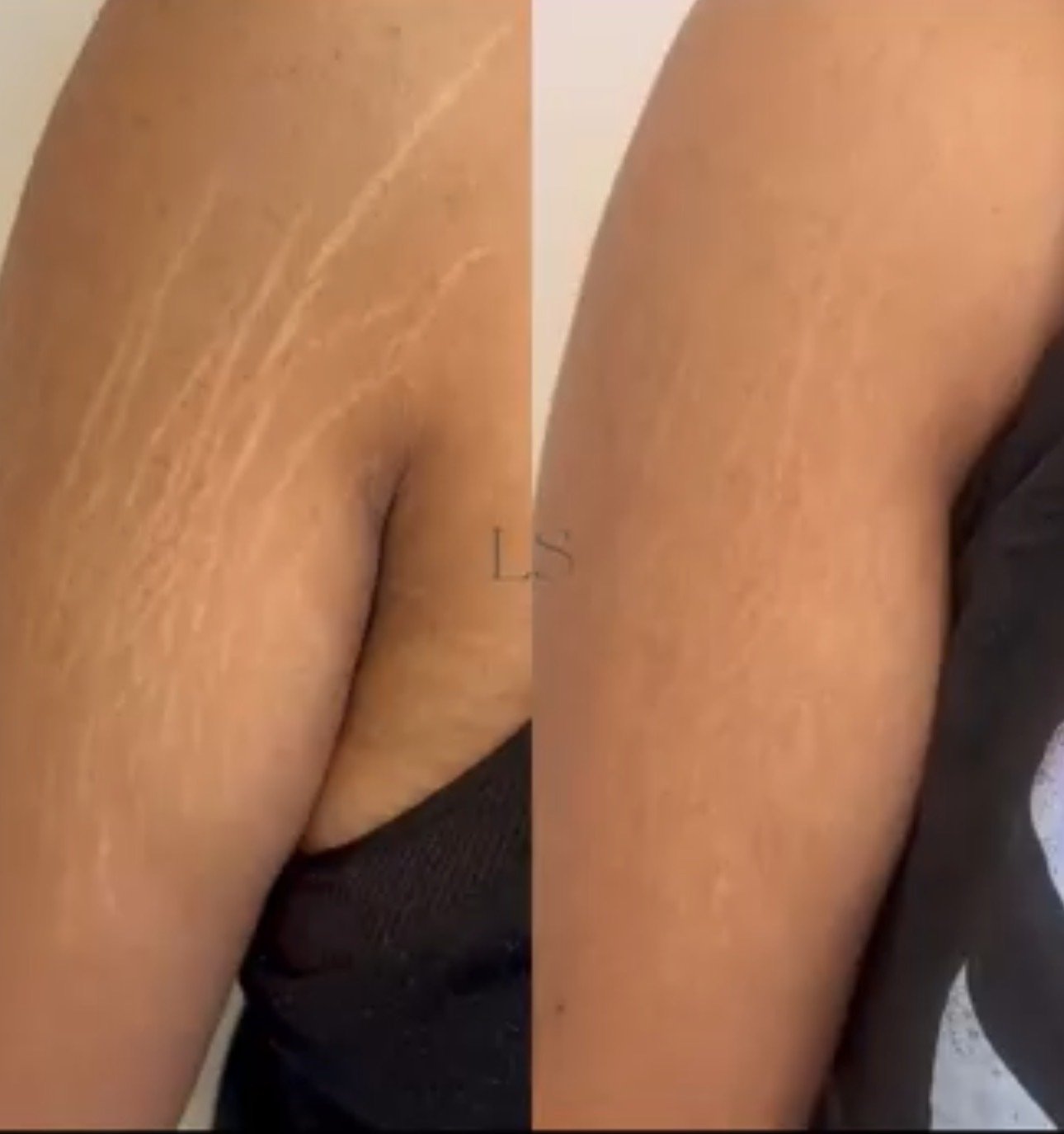 Side-by-side comparison of a person's upper arm, showing before and after appearance of skin treatment, with visible reduction in skin lines and blemishes.