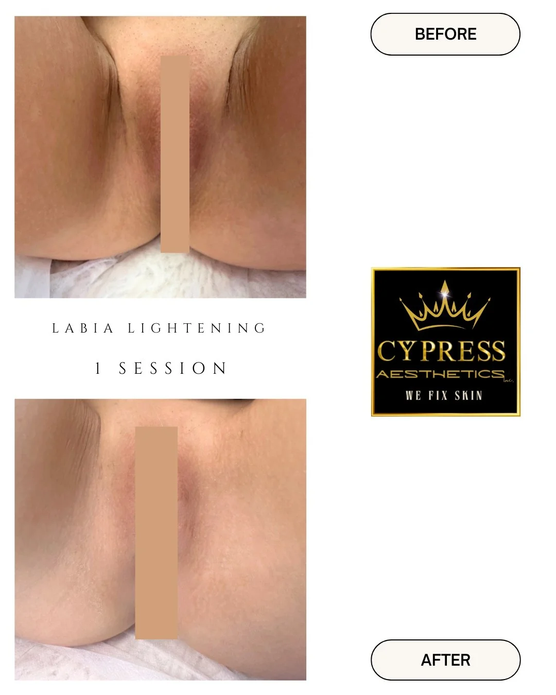 Before and after images of labia minora after one session of labia lightening treatment by Cypress Aesthetics, showing lighter skin in the "after" image.