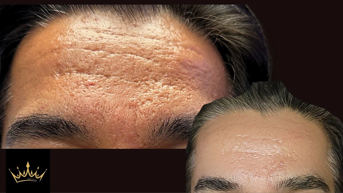 Say Good-Bye to Acne Scars with our highly targeted, non-laser approach. Our advanced techniques offer unparalleled precision and lasting results that traditional methods simply can't match. 💯

We utilize clinically proven methods to help you achiev
