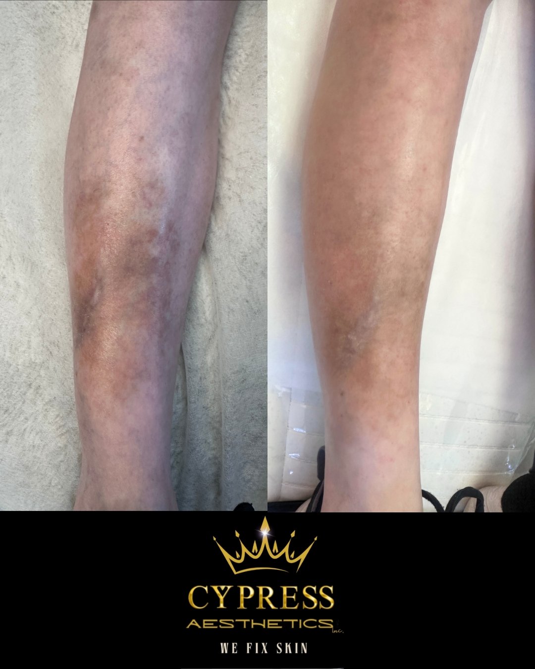 WOW, right?! 😍✨ Just wait until you see the stunning final result of this incredible transformation! The Magic of Camouflage Tattooing is truly something else! 🎨💖 Look at how amazing it already looks!  Got stretch marks or scars that you want to b