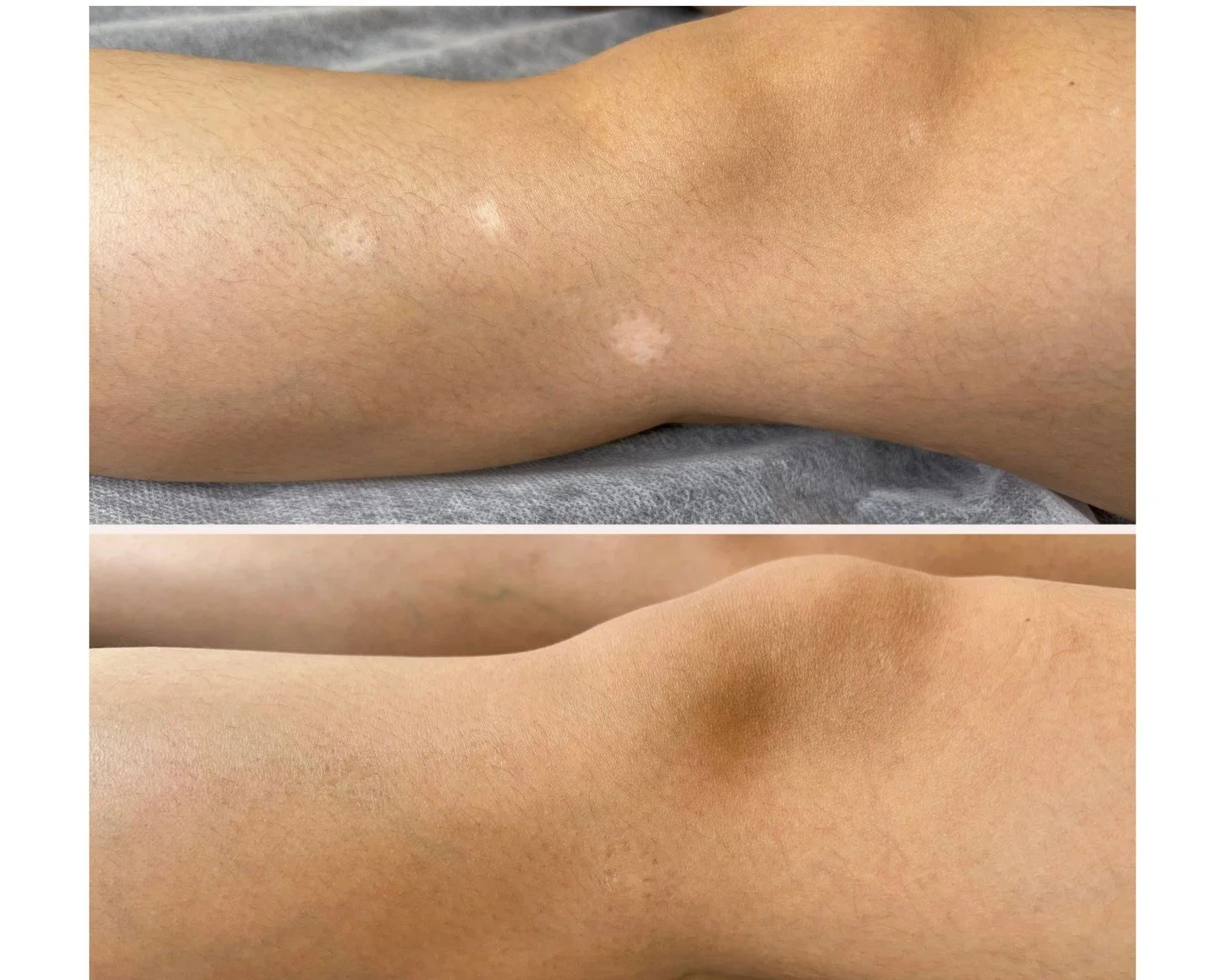 We love lasers. We also know what they can't do.

A laser can't bring back pigment. White scars need colour, so we replace it, matched to your skin with the Nue&reg; Reader.

Book online at bookskin.as.me or visit vancityskin.com (link in bio).

#Van