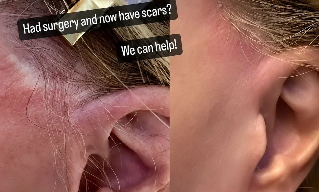 Skin reader first, pigment second.

The Nue&reg; Reader measures your exact skin tone so we can match colour with precision. It's how we approach white scars that laser couldn't touch.

Book online at bookskin.as.me or visit vancityskin.com (link in 
