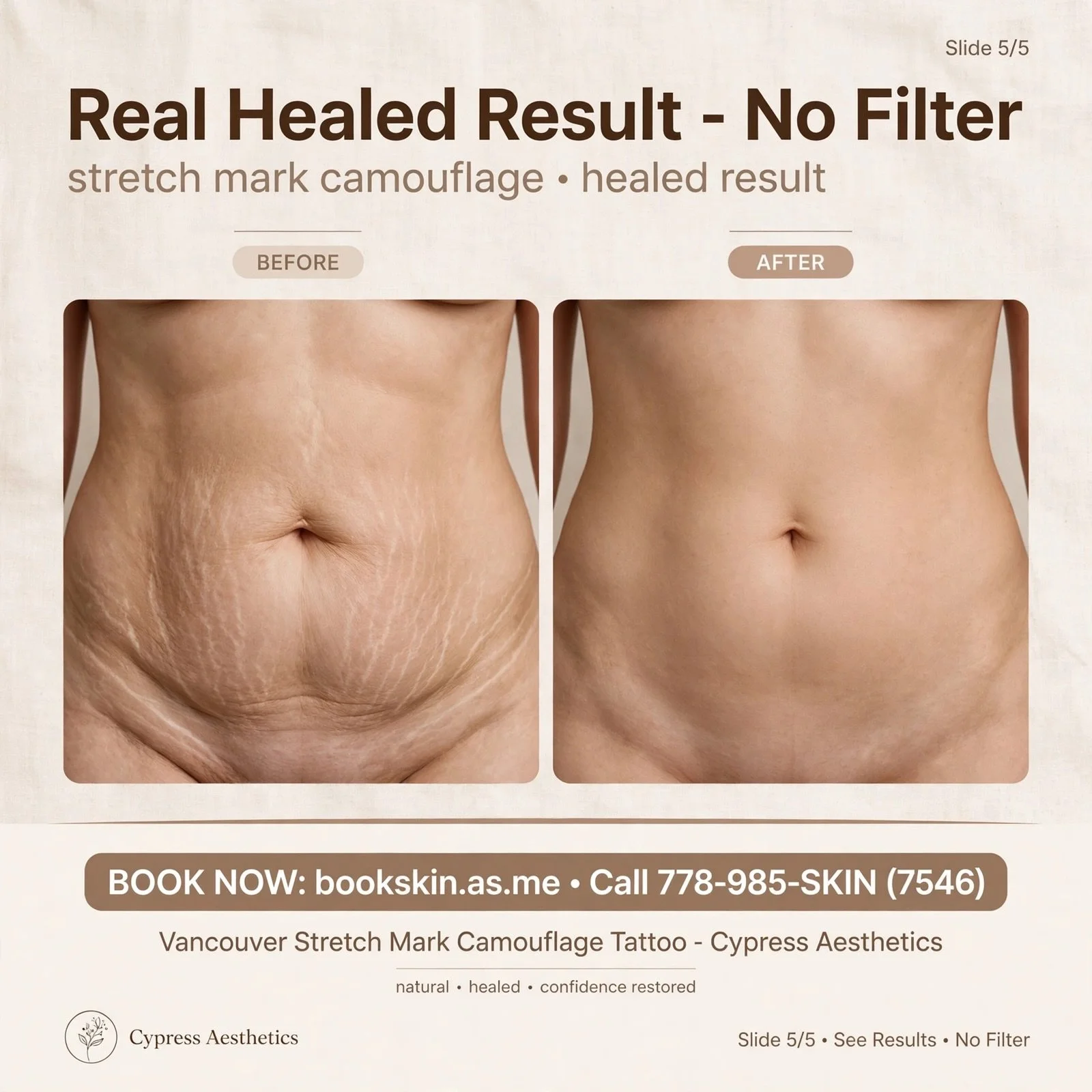 Three lasers. Still no change? That&rsquo;s not your fault.

Scars have 2 problems:
1) COLOR (pink, brown, white pigmentation)
2) TEXTURE (dented, raised, tight, shiny)

Laser only hits COLOR. If your scar is textured, you need texture-first: inkless