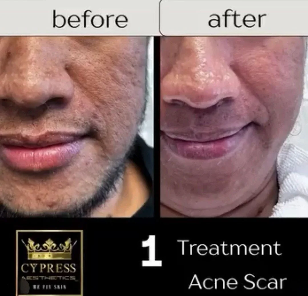 You tried laser. Maybe more than once. Your acne scars are still there.

That is not a reflection on you. It is usually a sign the approach did not match the scar. Laser is not the answer to every scar type, and an honest provider will tell you that.