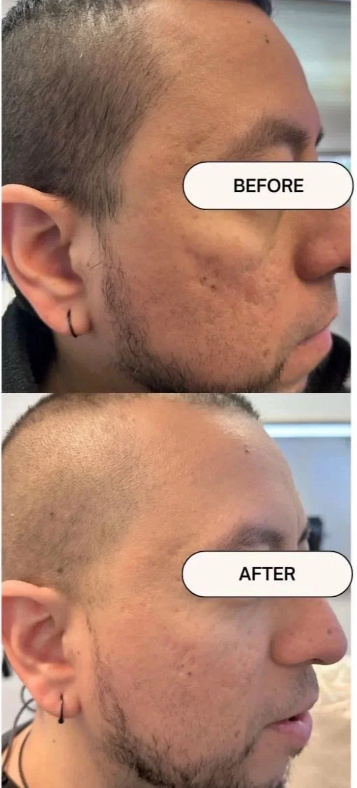 Side-by-side comparison of a man's scalp showing before and after a hair treatment, with the top labeled 'BEFORE' showing thinning and patchy hair, and the bottom labeled 'AFTER' showing a shaved head with fuller, evenly distributed hair.