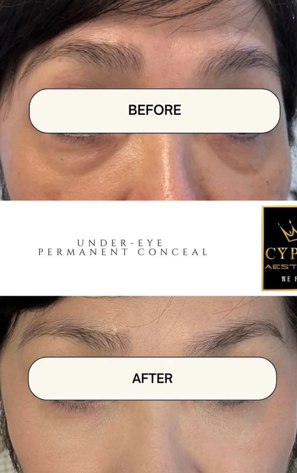 Comparison of a person's under-eye area showing before and after results of permanent under-eye concealing treatment, with the before image showing more darkness and puffiness, and the after image showing a smooth, brightened appearance.