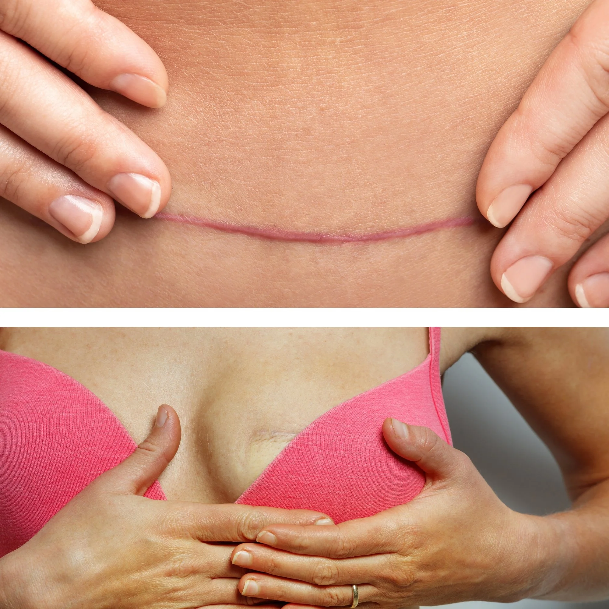 Close-up of a woman with hands on her stomach, wearing a pink top, showing a tummy with a visible surgical scar.
