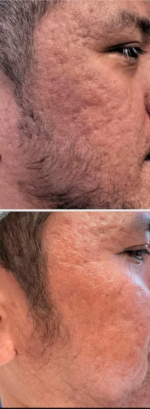 Close-up images of a person's face showing the skin condition before and after treatment, with the second image showcasing clearer, smoother skin.