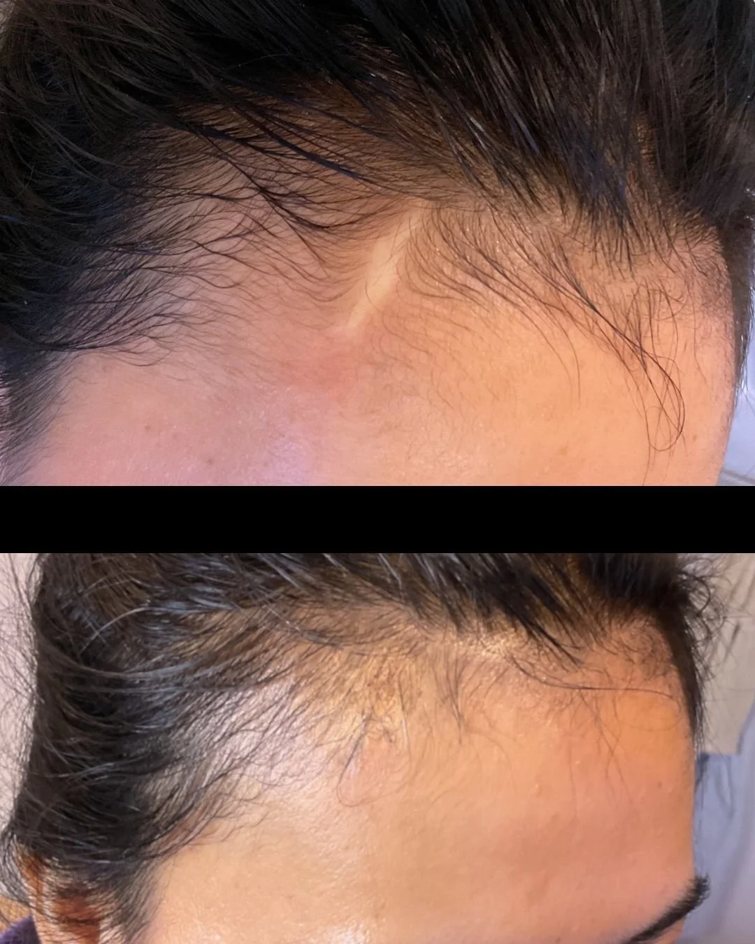 Close-up of a person's hairline before and after hair transplant, showing improved hair density and coverage in the after image.
