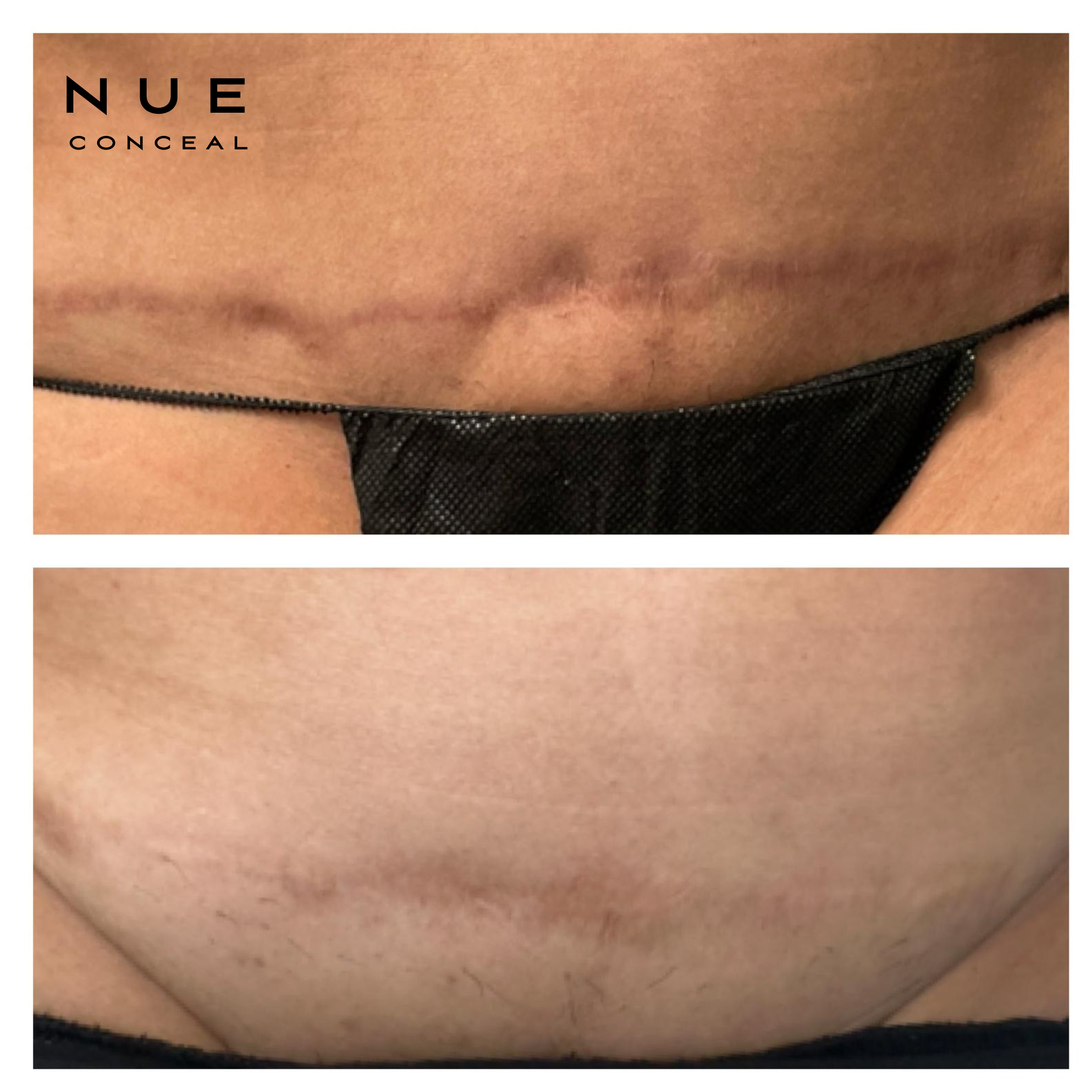 Close-up of a person's skin with some hair and a stretch mark.