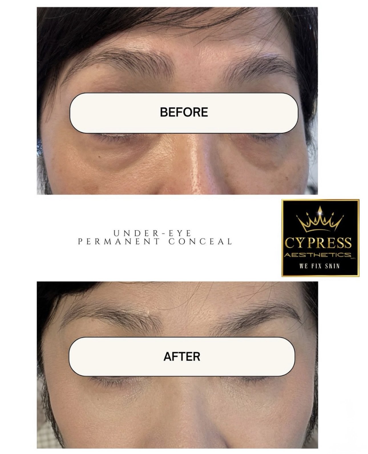 Close-up of a person's face before and after under-eye cosmetic procedure with text indicating 'Before' and 'After', showcasing reduced under-eye puffiness and dark circles, with logo for Cypress Aesthetics.