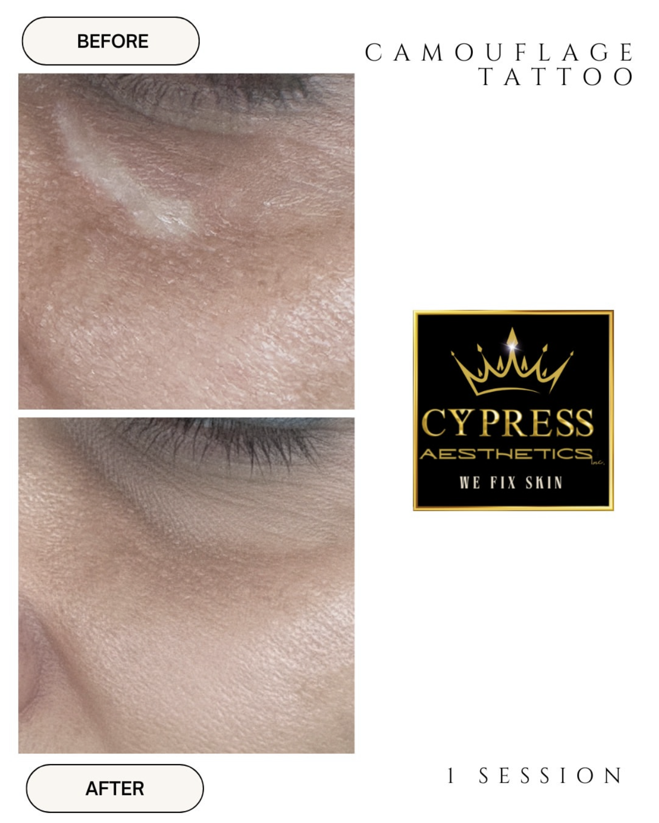 Comparison photo showing the skin around an eye before and after a camouflage tattoo treatment, with the results displayed after one session by Cypress Aesthetics.