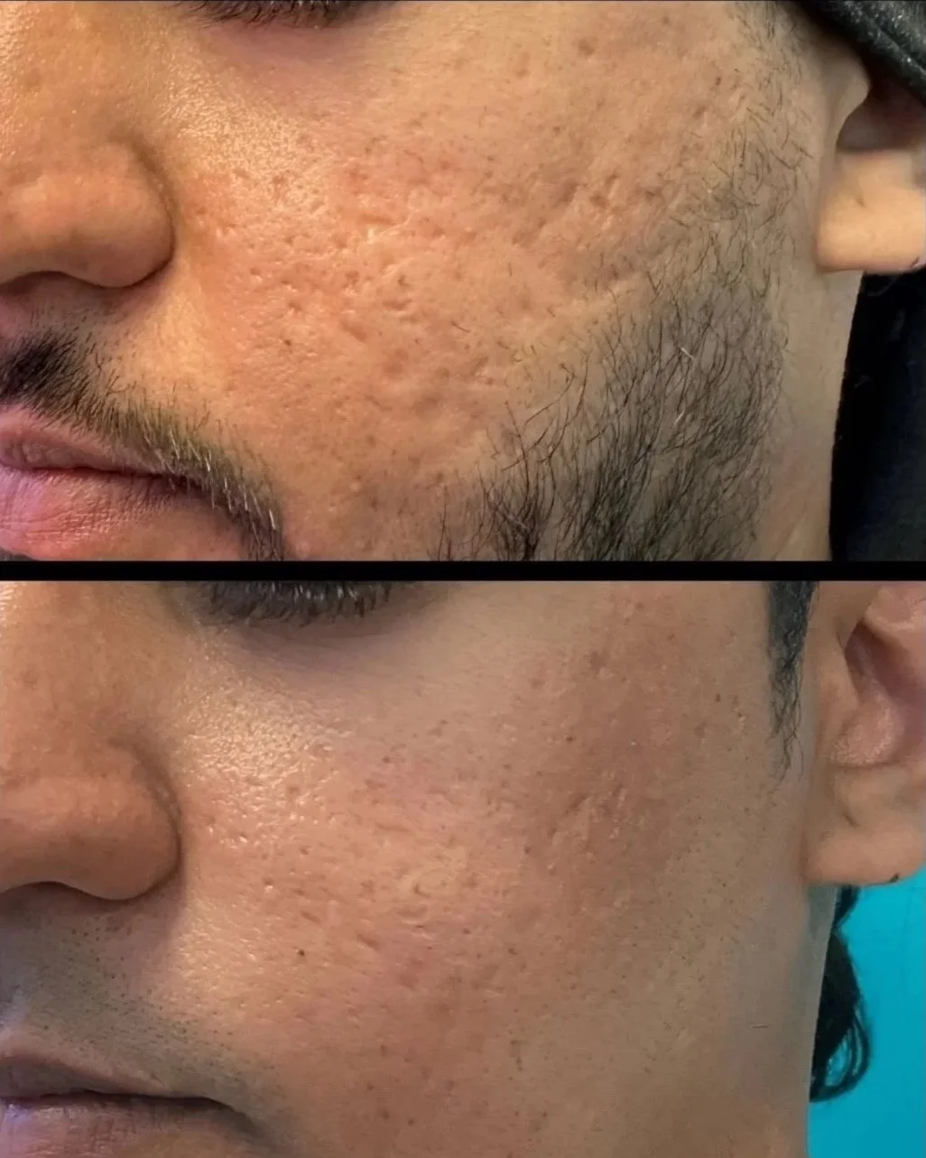 Before and after close-up images of a man's cheek and jawline showing improvements in skin texture and reduction of acne scars or pores.