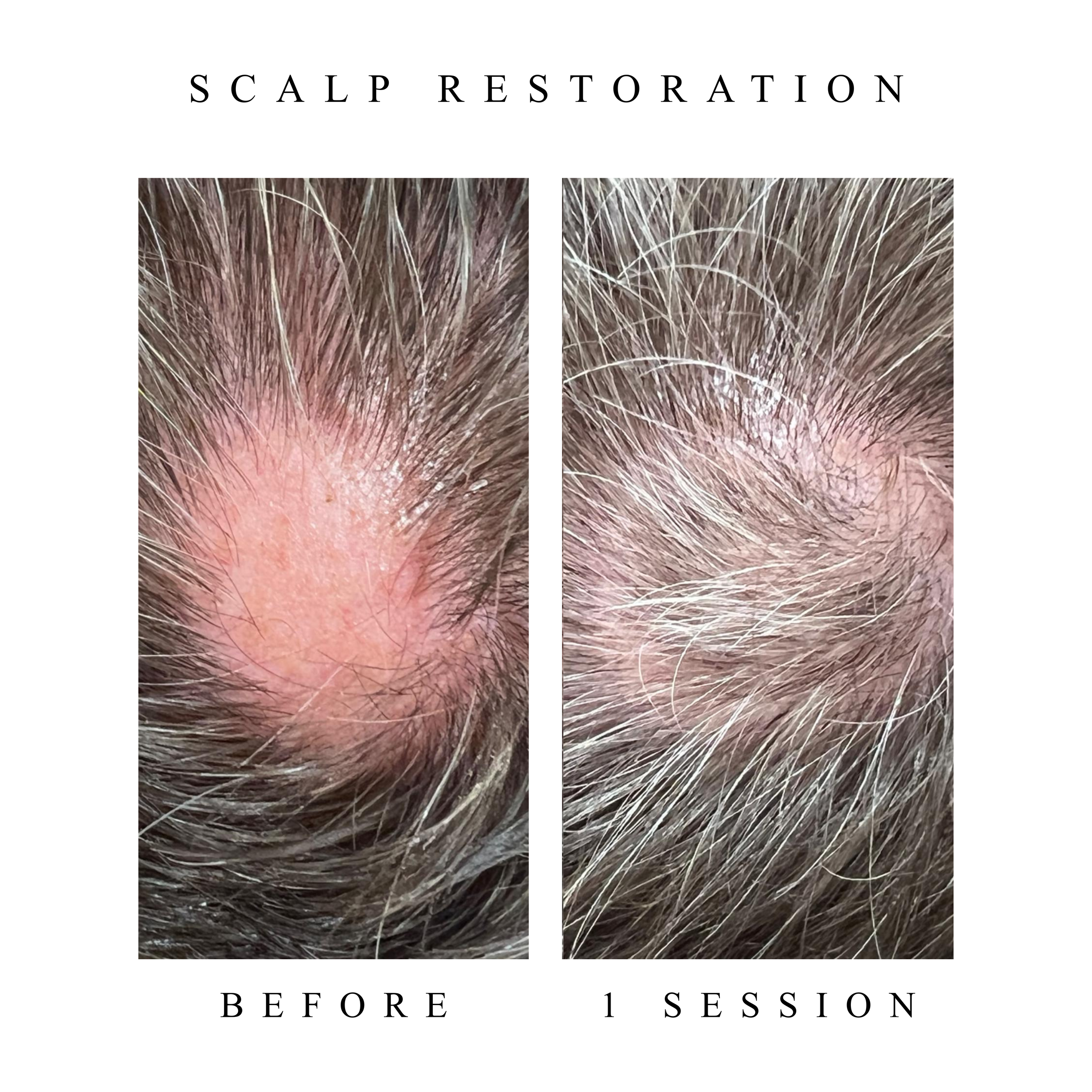 hair growth, regeneration, hair follicule growth, receding hair