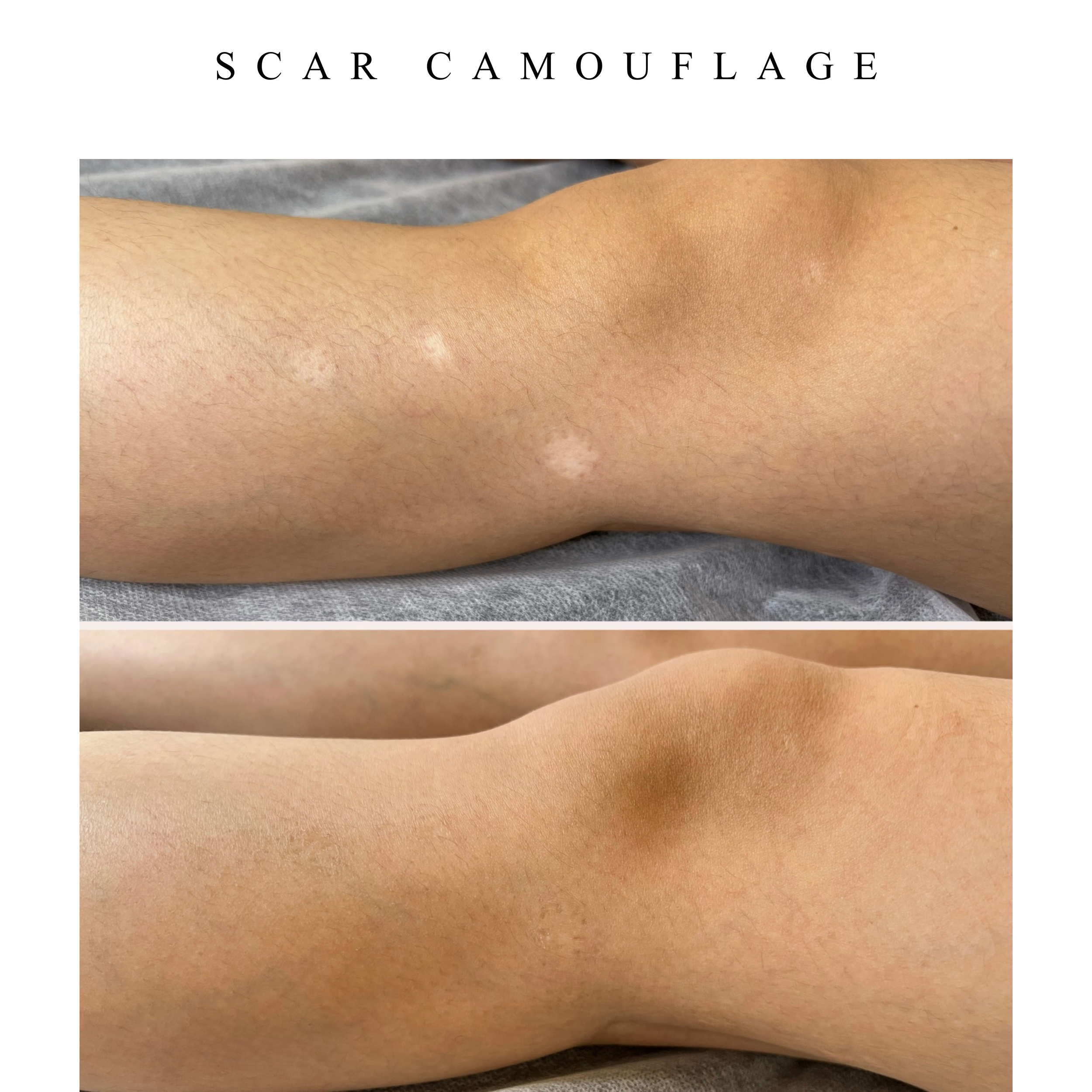Close-up image of a human arm showing skin with several small scars.
