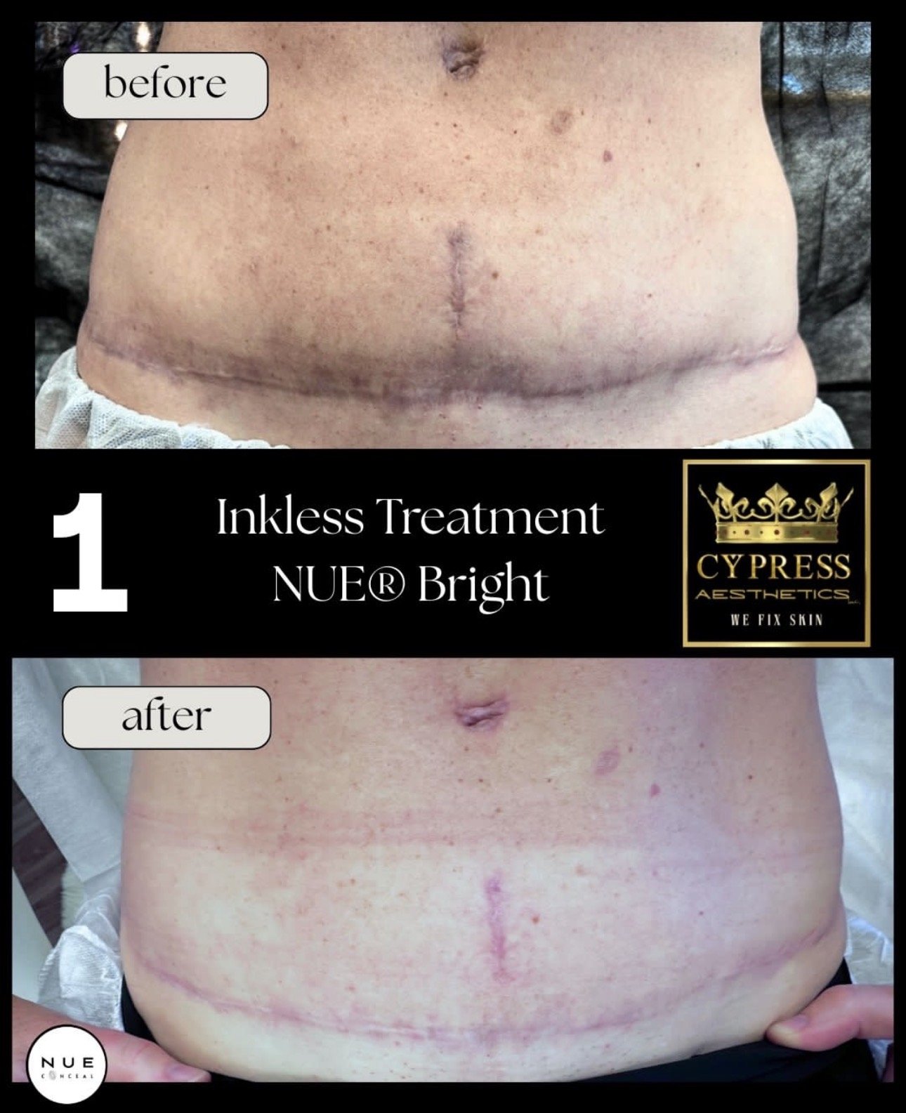 Before and after images of a person's abdomen showing the results of inkless treatment with NEU Bright at Cypress Aesthetics. The 'before' image shows a scar and skin discoloration, while the 'after' image shows a clearer, more even skin tone with reduced scar visibility.