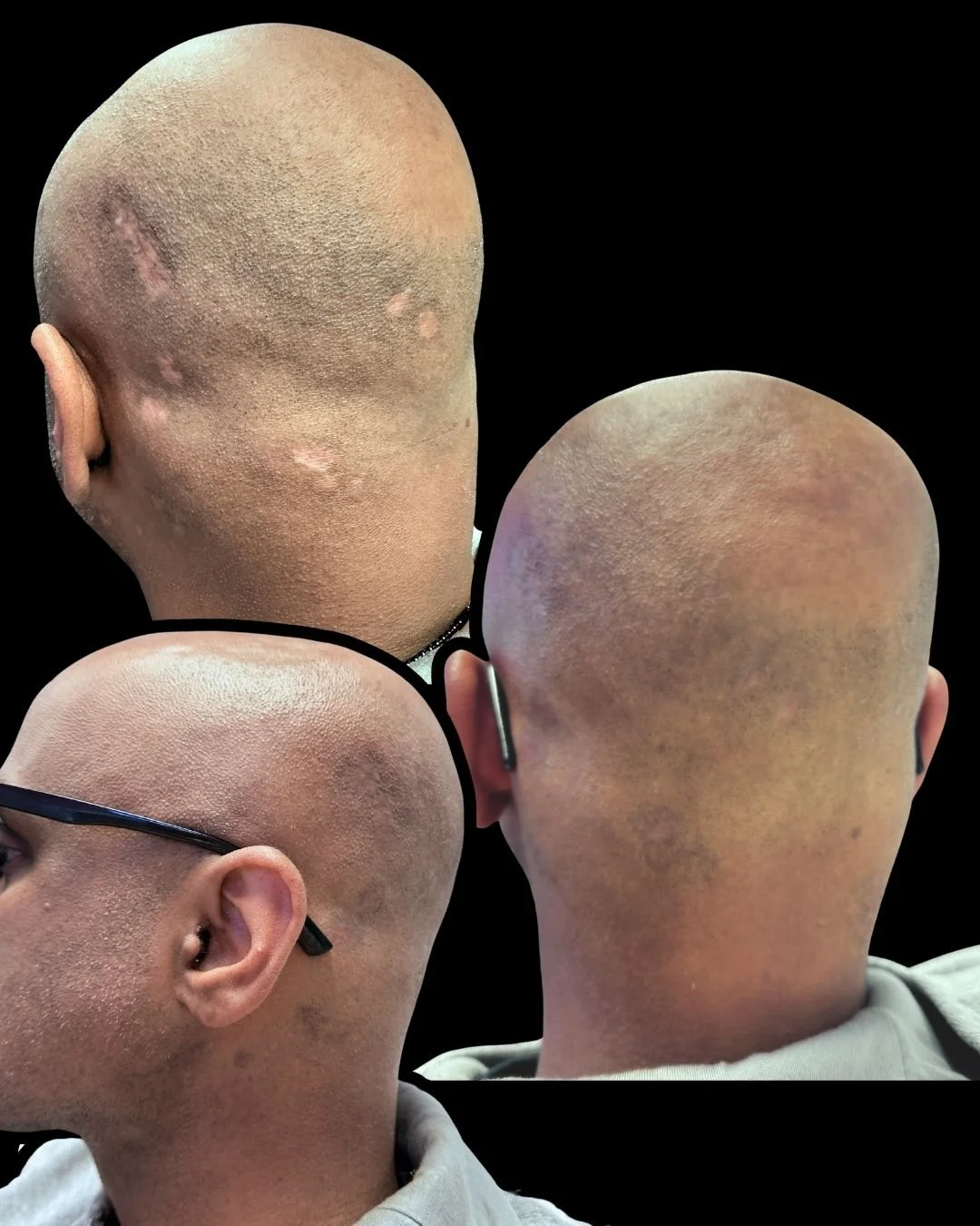 Collage of four bald heads with varying skin conditions, some with scars and uneven skin texture, against a black background.