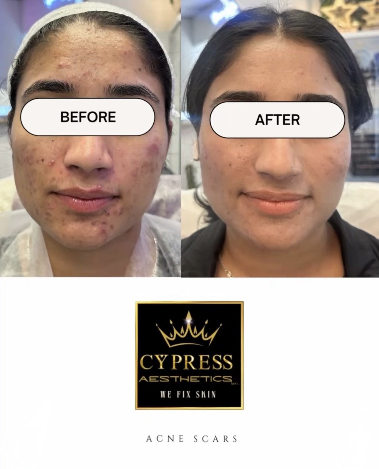 Before and after photos showing a woman's face with acne scars, with the after photo showing clear skin, promoting Cypress Aesthetics for skin correction.