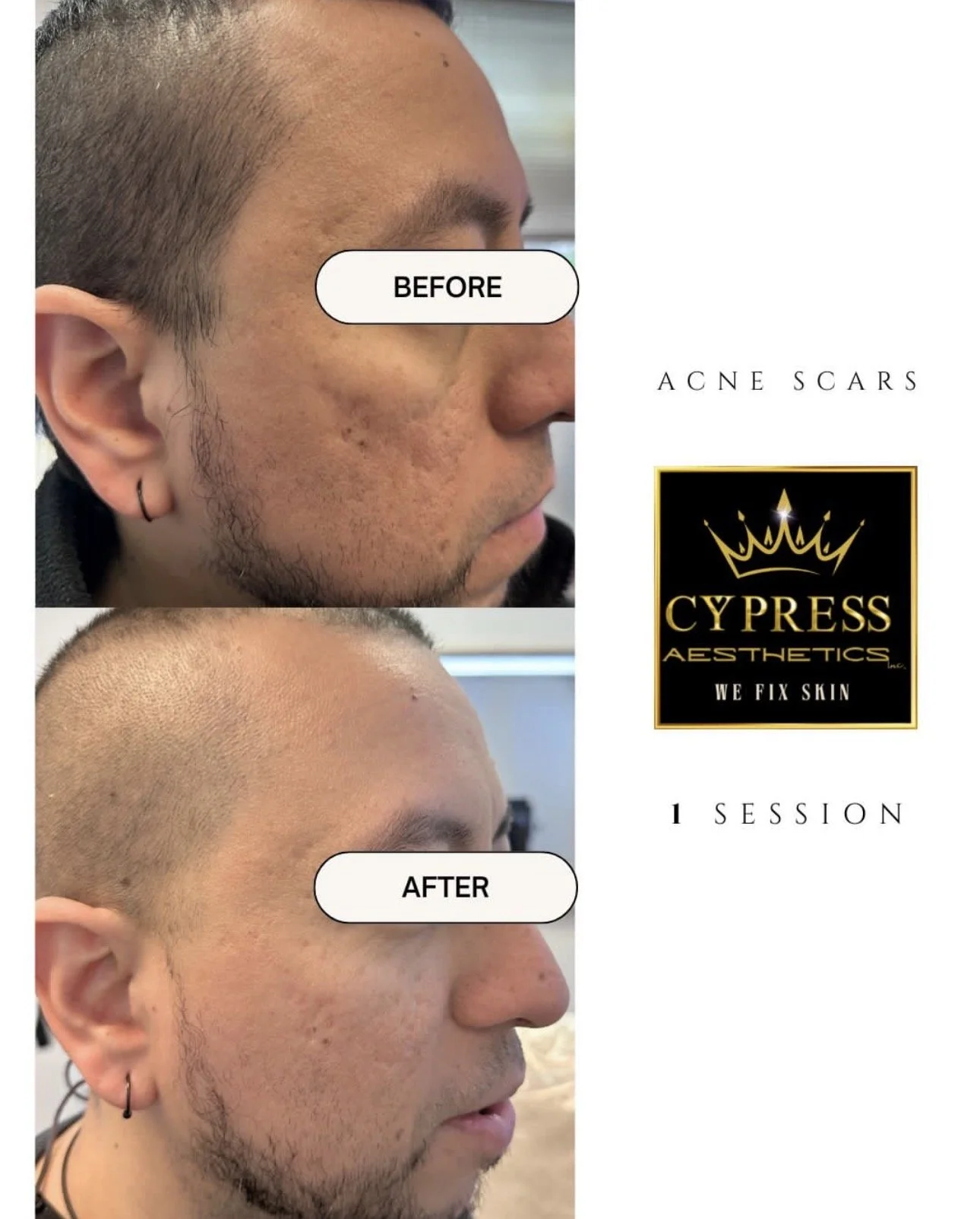 A side-by-side comparison of a man's face before and after a treatment for acne scars. The 'before' photo shows prominent acne scars, while the 'after' photo shows smoother skin. The image includes the logo for Cypress Aesthetics and indicates one session of treatment.
