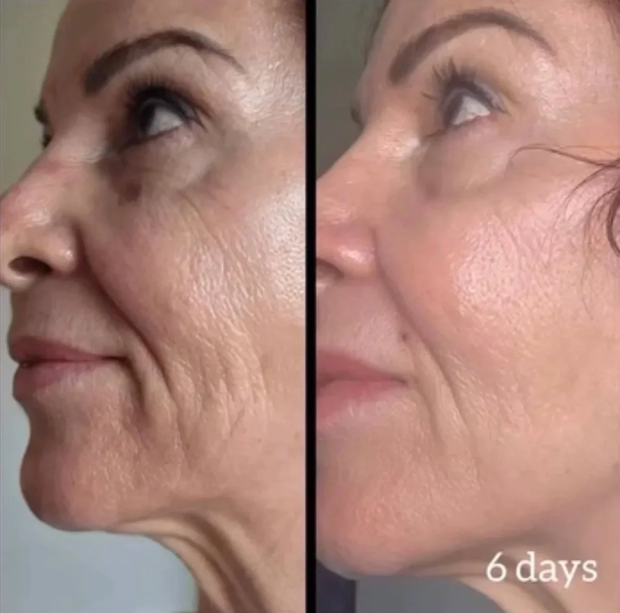 Side-by-side comparison of a woman's face showing skin improvements over six days, with visible reduction in wrinkles and smoother skin.