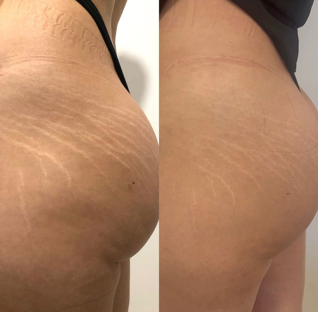 Close-up of a person's buttocks with prominent stretch marks, shown from two angles, wearing black underwear.
