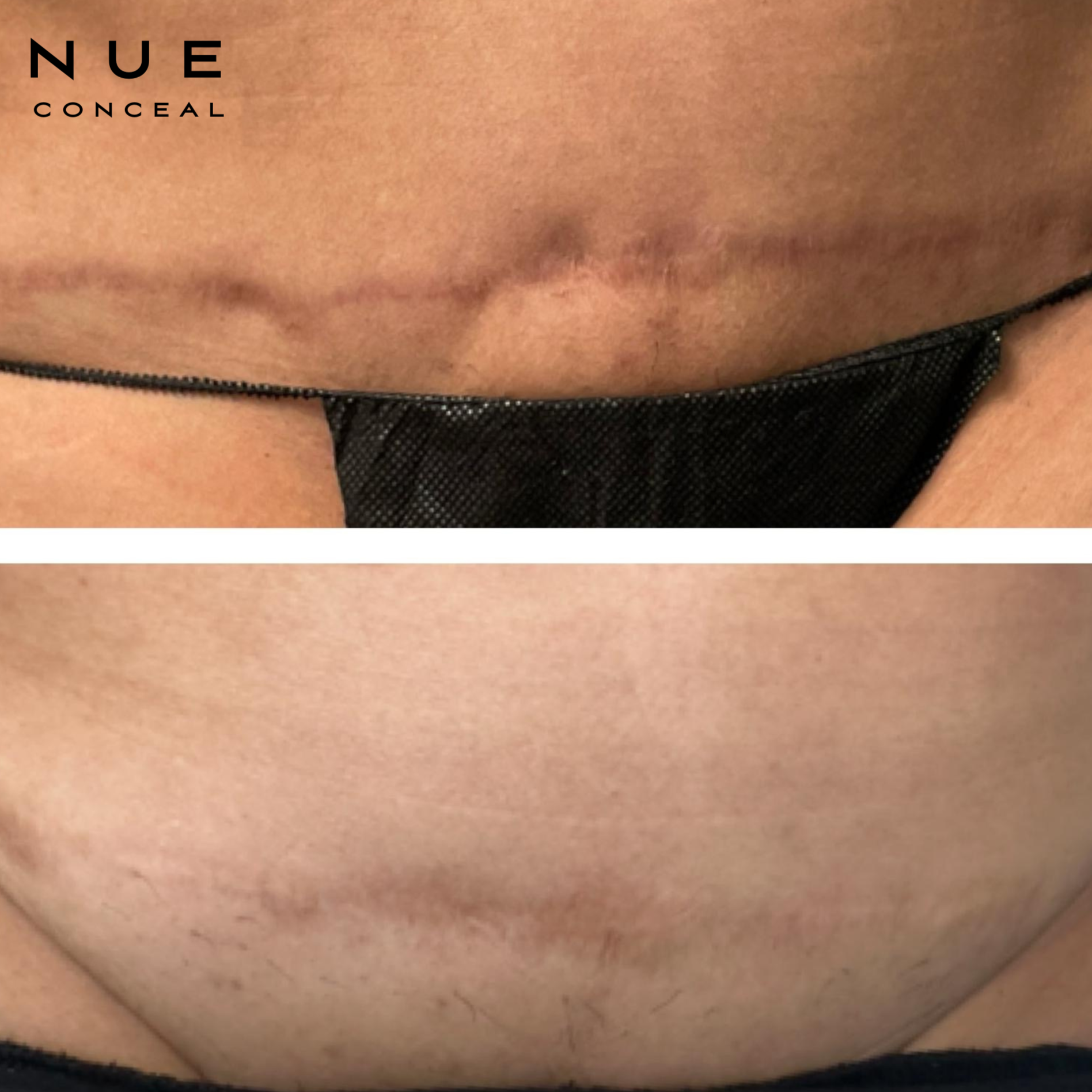 Close-up of a person's bare skin near the waist, with a small mole and part of black underwear visible.