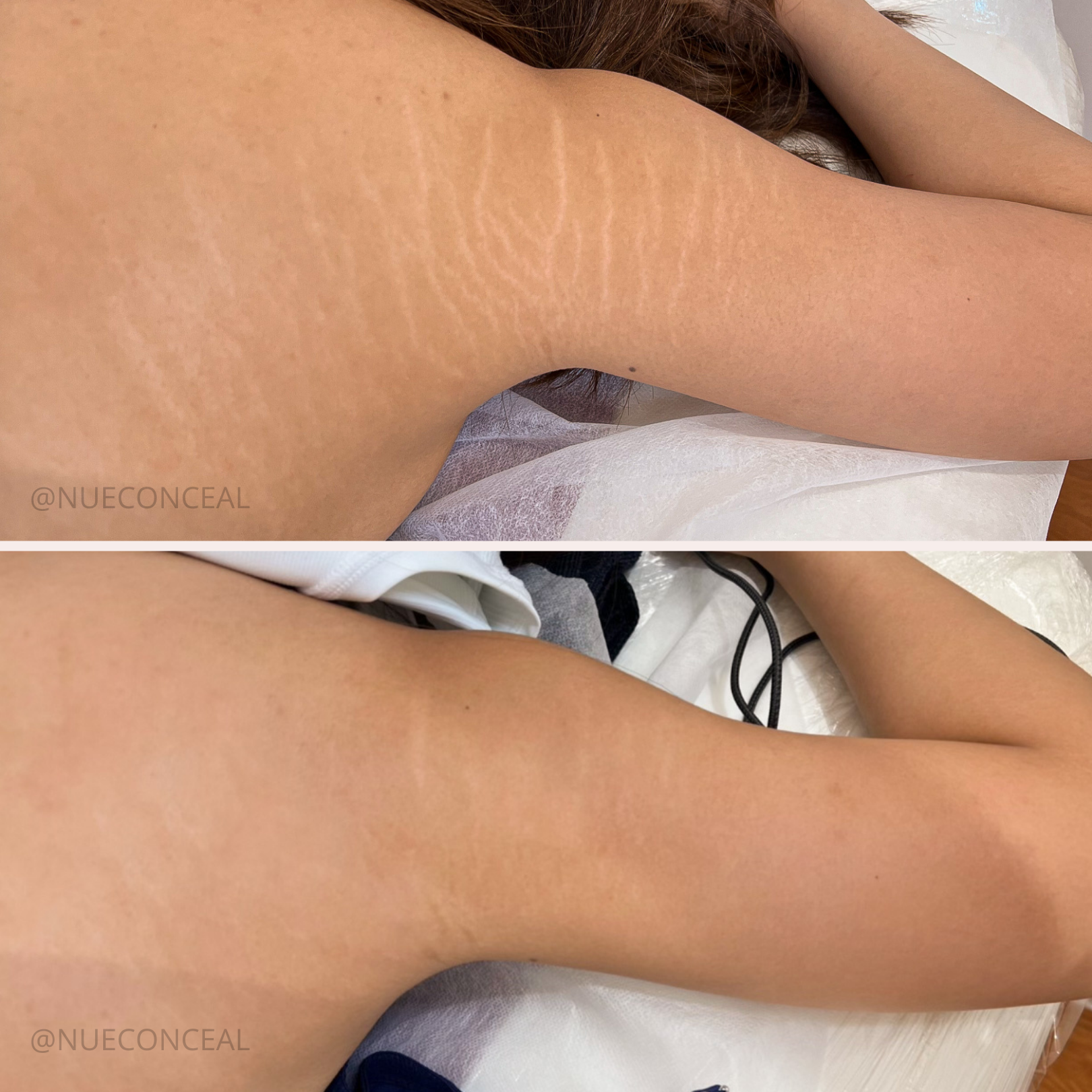 Close-up of person's bare back and arm, lying on a white surface, with brown hair visible at the top.