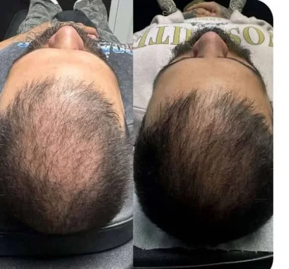 Comparison of a man's scalp before and after a hair treatment or hair transplant, showing increased hair density in the after image.