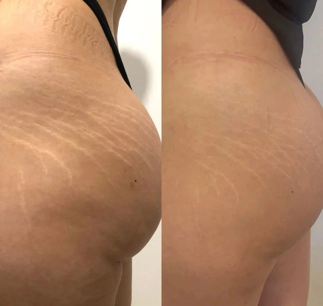 Comparison of a person's buttocks before and after treatment showing reduction in stretch marks.