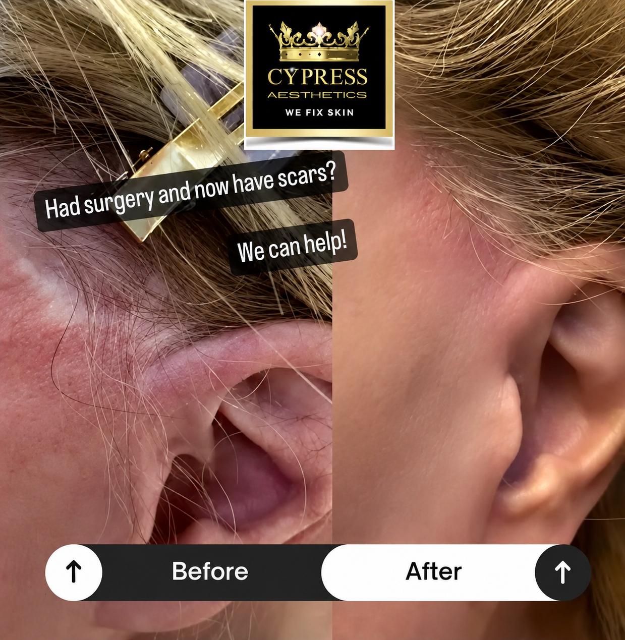 Side-by-side comparison of earlobes before and after skin scar treatment, with treatment center logo for Cypress Aesthetics and text saying, 'Had surgery and now have scars? We can help!'