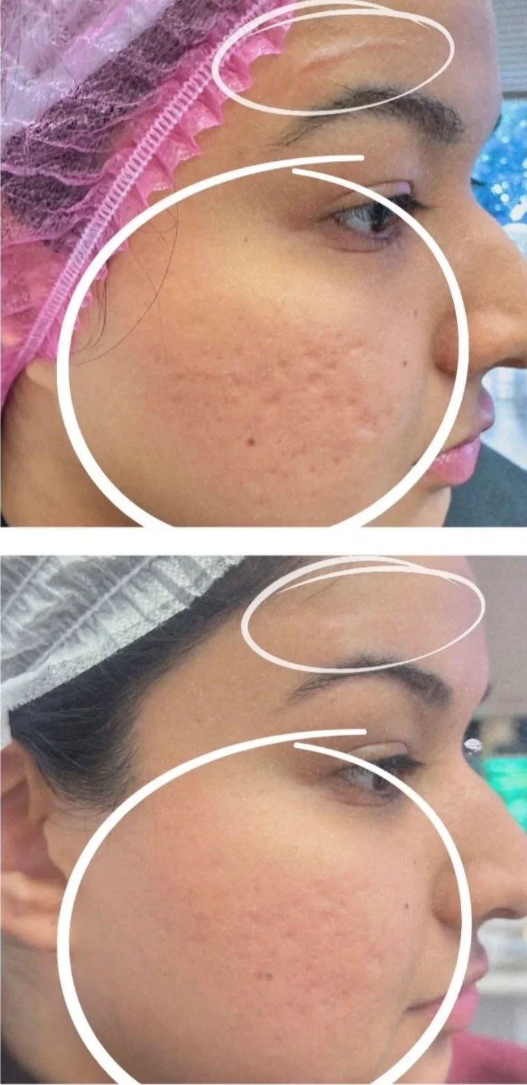 Before and after images showing a person's face with skin imperfections, such as acne scars and texture, improving after skincare or treatment, with a close-up of the cheek area.